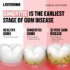 Does Listerine Clinical Solutions Mouthwash Really Prevent Gum Disease Review Worth Reading Does Listerine Clinical Solutions Mouthwash Really Prevent Gum Disease Review Worth Reading